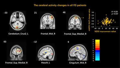 The Role of Medial Prefrontal Cortex in Acupuncture Treatment for Functional Dyspepsia